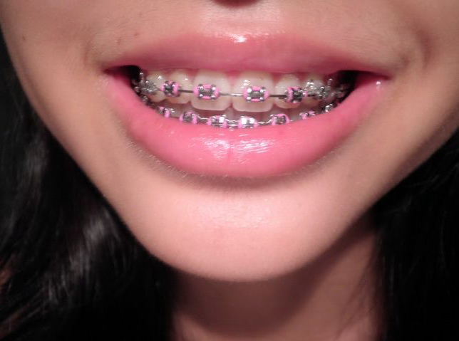 dental braces